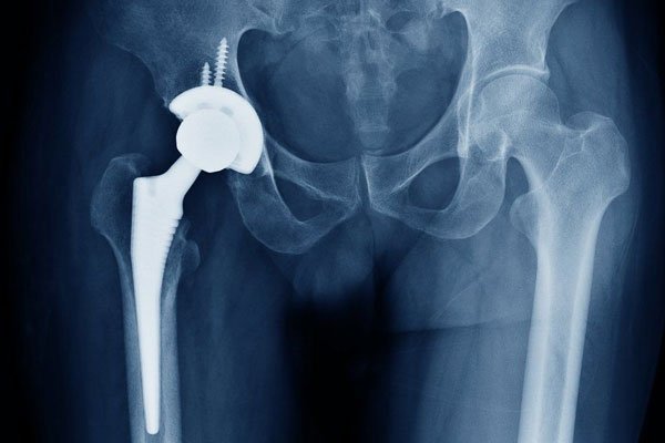   Hip joint Replacement