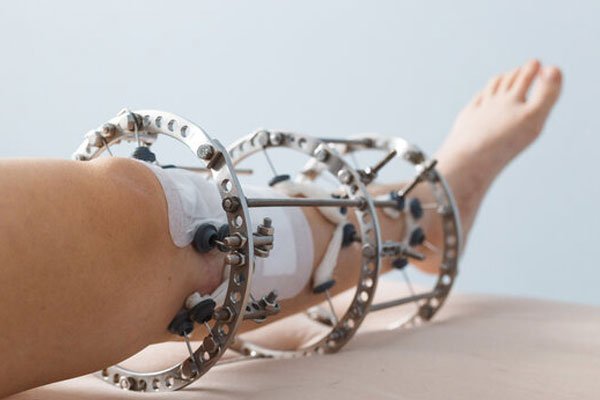 Ilizarov Surgery