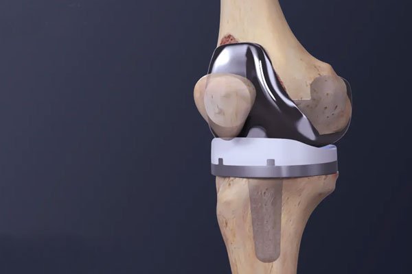   Knee Joint Replacement