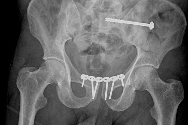 Pelvis & Acetabulum Surgery