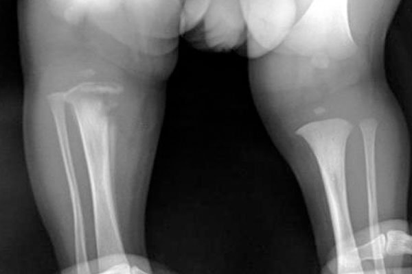 Bone and Soft tissue Infection management